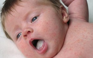 alergije i dojenje